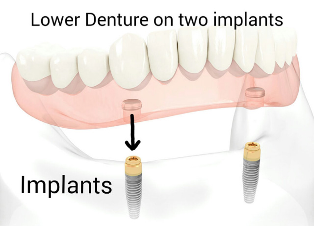 diagram showing denture lowered onto implants