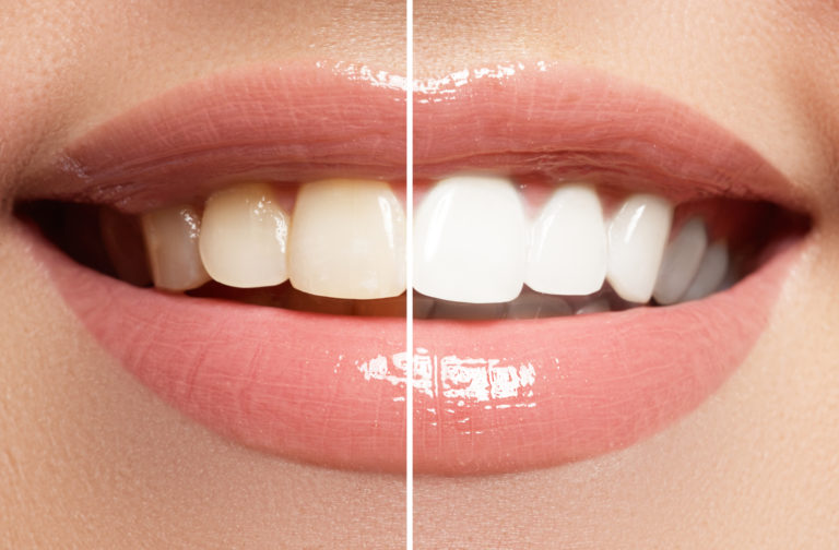 Whitening Example 1