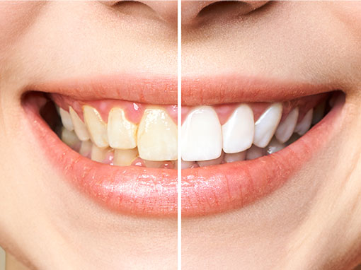 Whitening Example 2