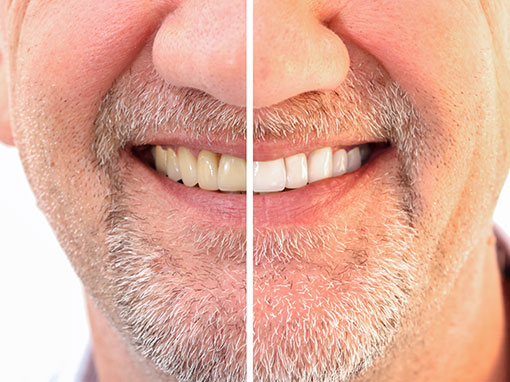 man smiling after receiving teeth whitening treatment