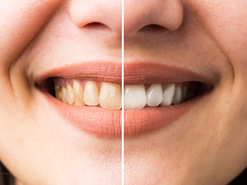 woman smiling after receiving teeth whitening treatment