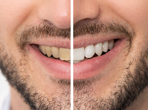 man smiling after receiving teeth whitening treatment