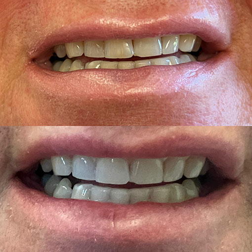 man showing teeth before whitening (above) and after whitening (below)
