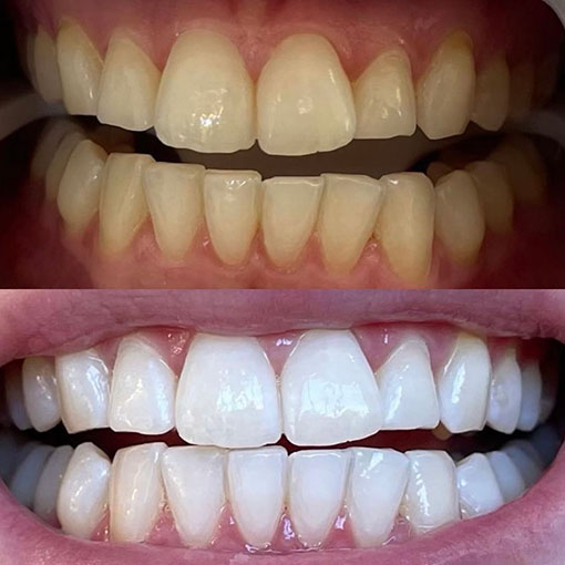 woman showing teeth before whitening (above) and after whitening (below)