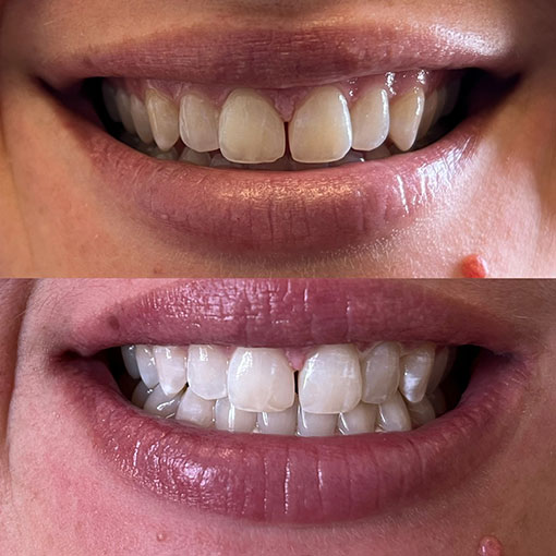 woman showing teeth before whitening (above) and after whitening (below)