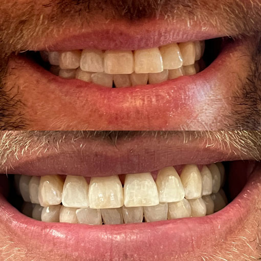 man showing teeth before whitening (top) and after whitening (bottom). Teeth look significantly whiter